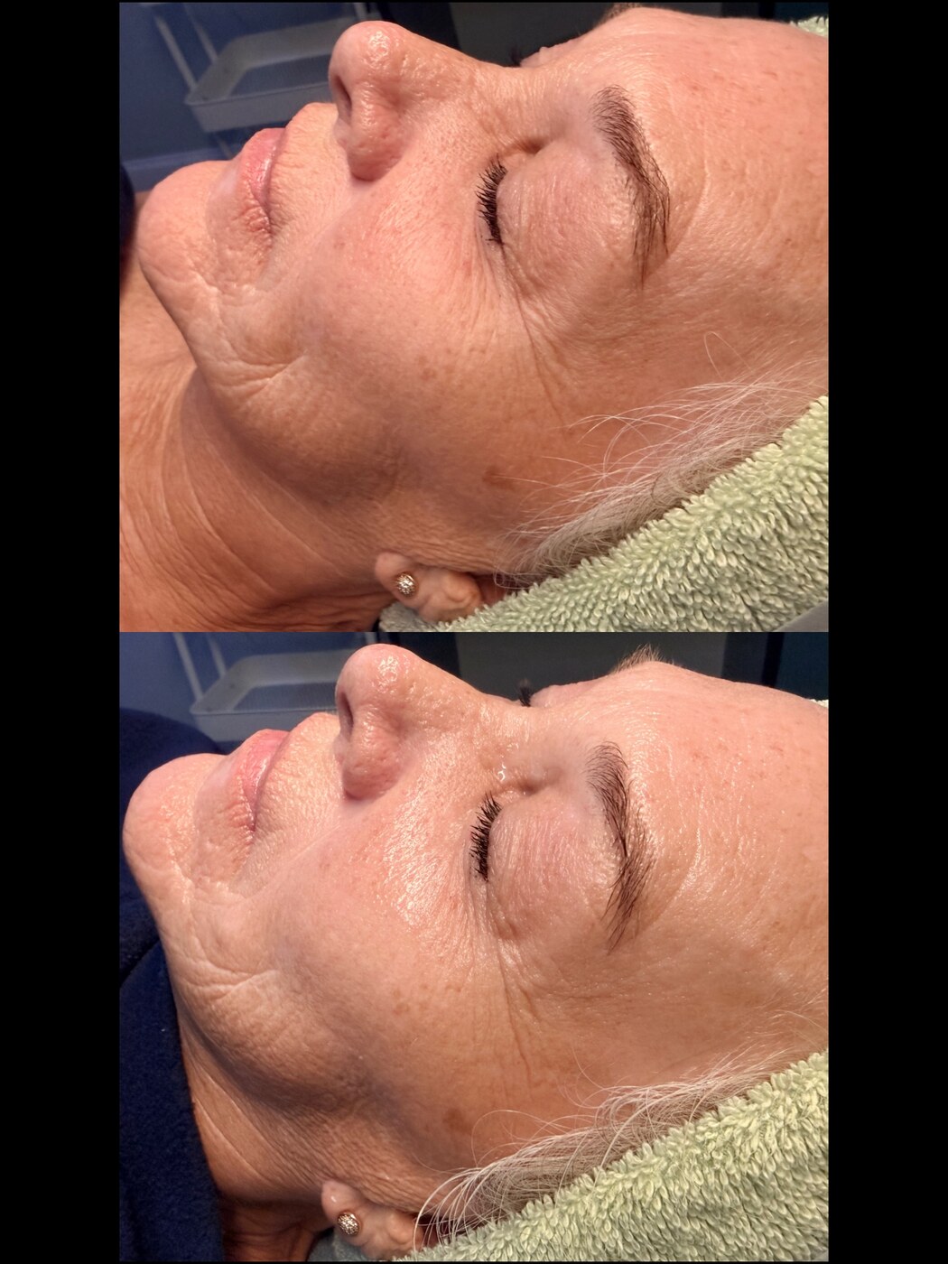 Before and after dermal filler at Serene Med Spa Barboursville