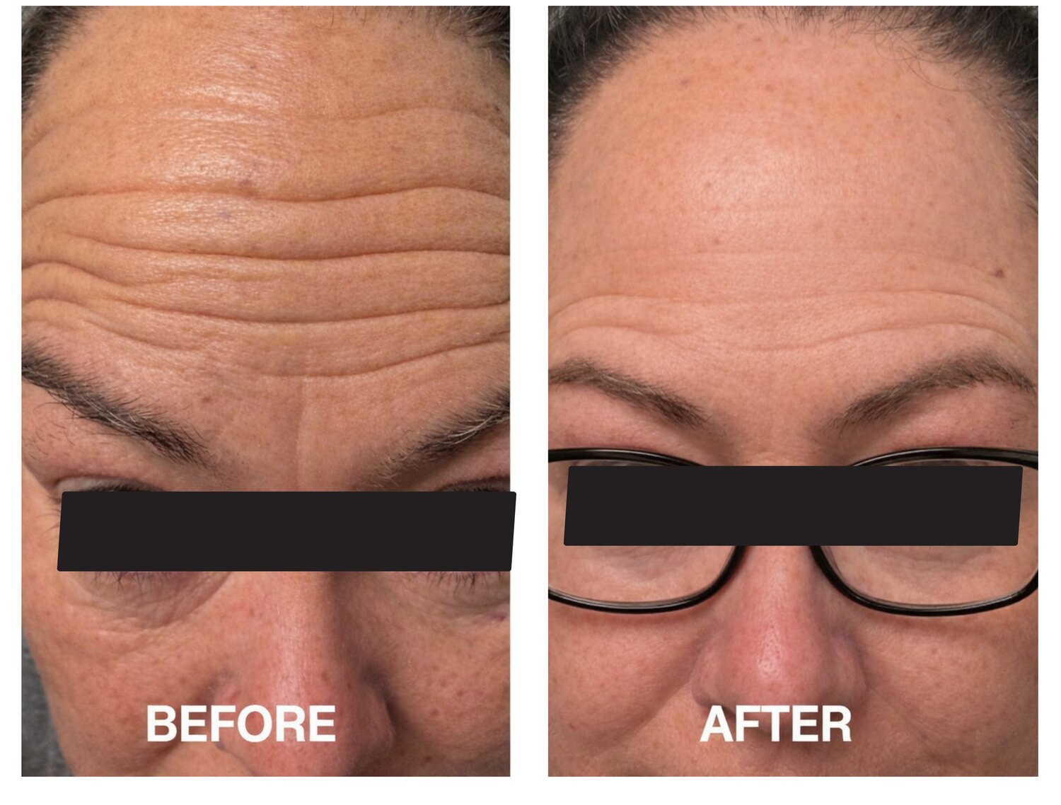 Before and after wrinkle-relaxer treatment at Serene Med Spa Barboursville