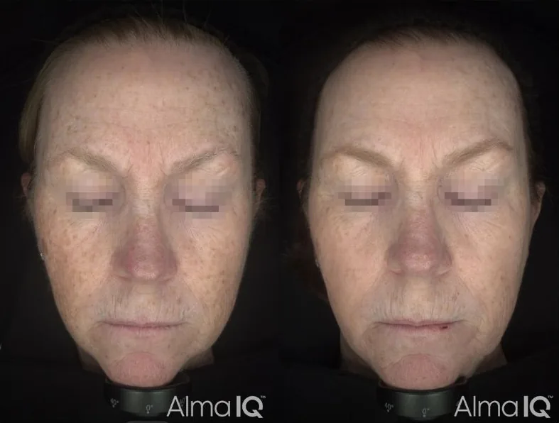 Harmony Bio-Boost before and after, daylight view, one month after one treatment