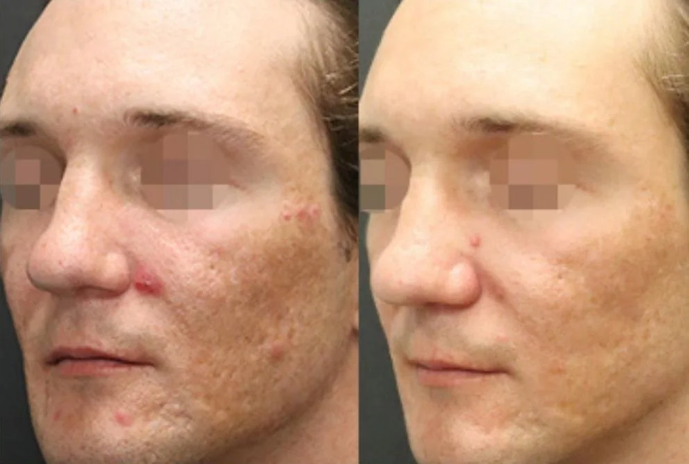 Alma Hybrid before and after: acne scars and active acne, after 1 treatment