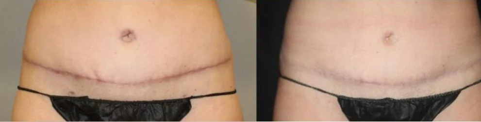 Alma Hybrid before and after: surgical scar on the abdomen, after 2 treatments