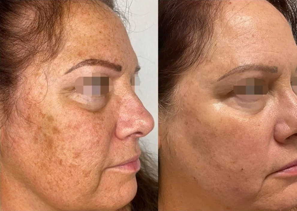 Alma Hybrid before and after: sun damage and pigment, after 2 treatments