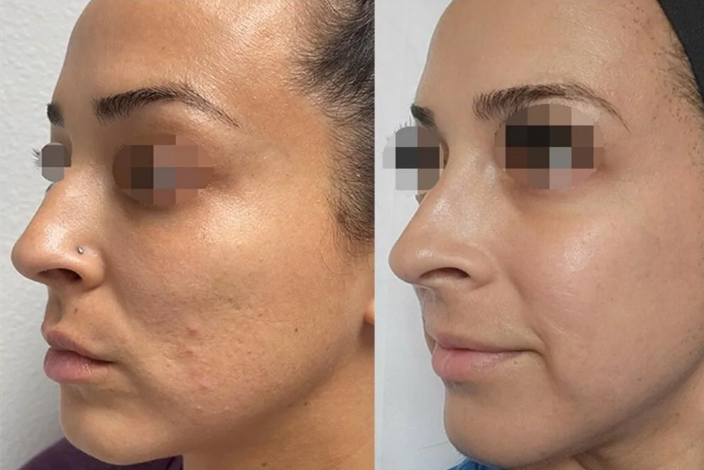 Alma Hybrid before and after: texture and pores, after 2 treatments