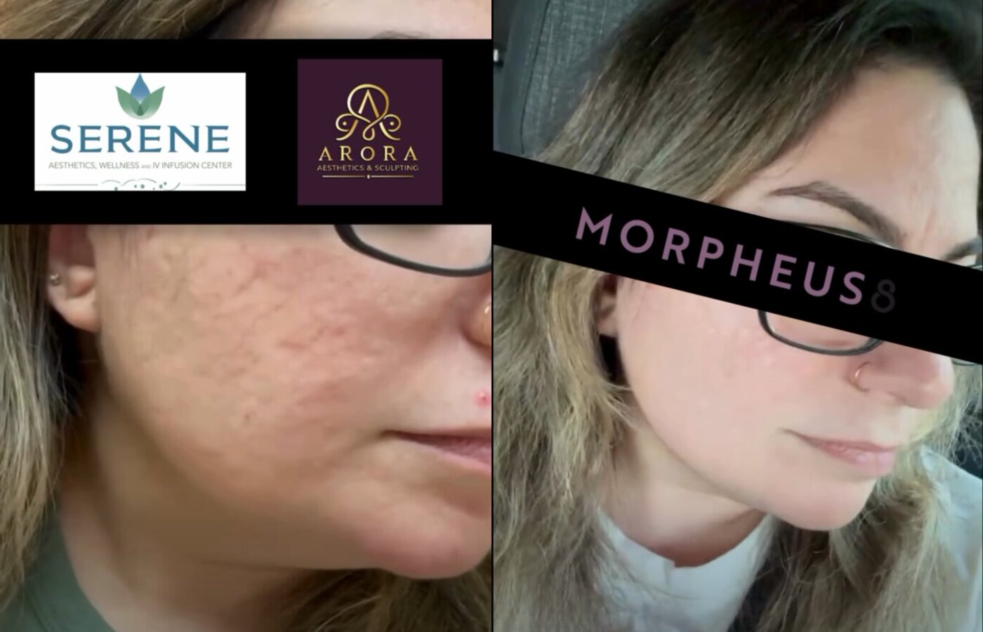 Before and after Morpheus8 skin resurfacing