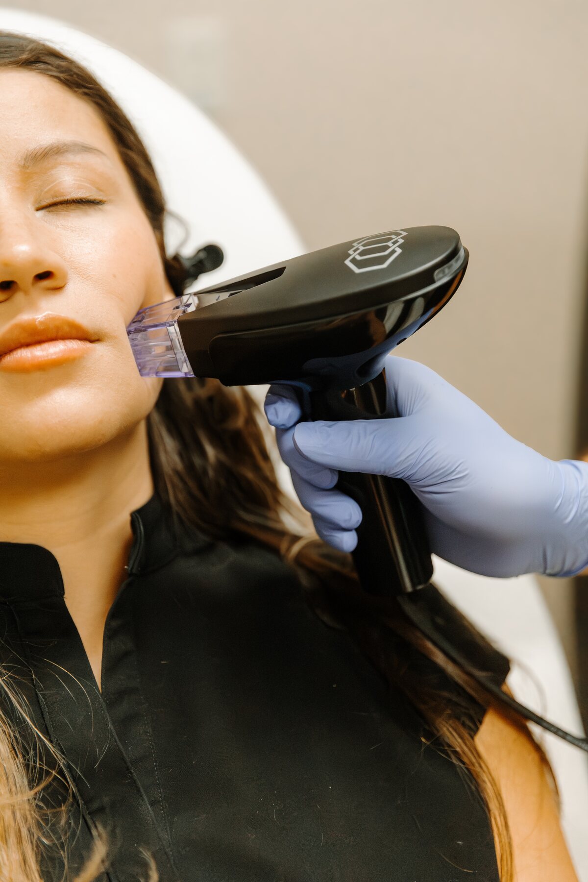 Morpheus8 microneedling in Barboursville