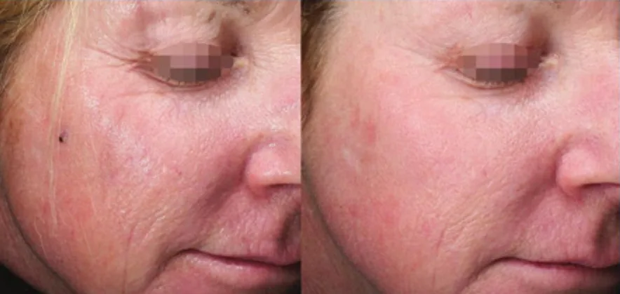 Opus Plasma before and after: cheek texture and fine lines, after 1 treatment