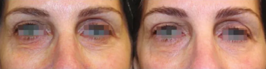 Opus Plasma before and after: under-eye and crow's feet, after 1 treatment