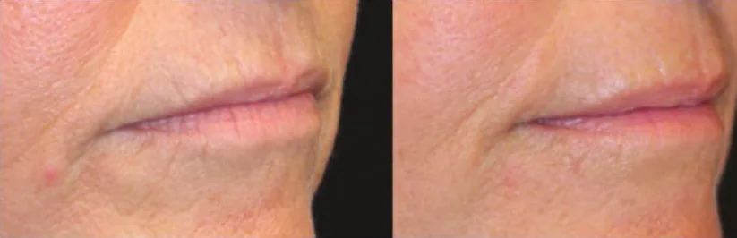Opus Plasma before and after: lines around the mouth, after 2 treatments