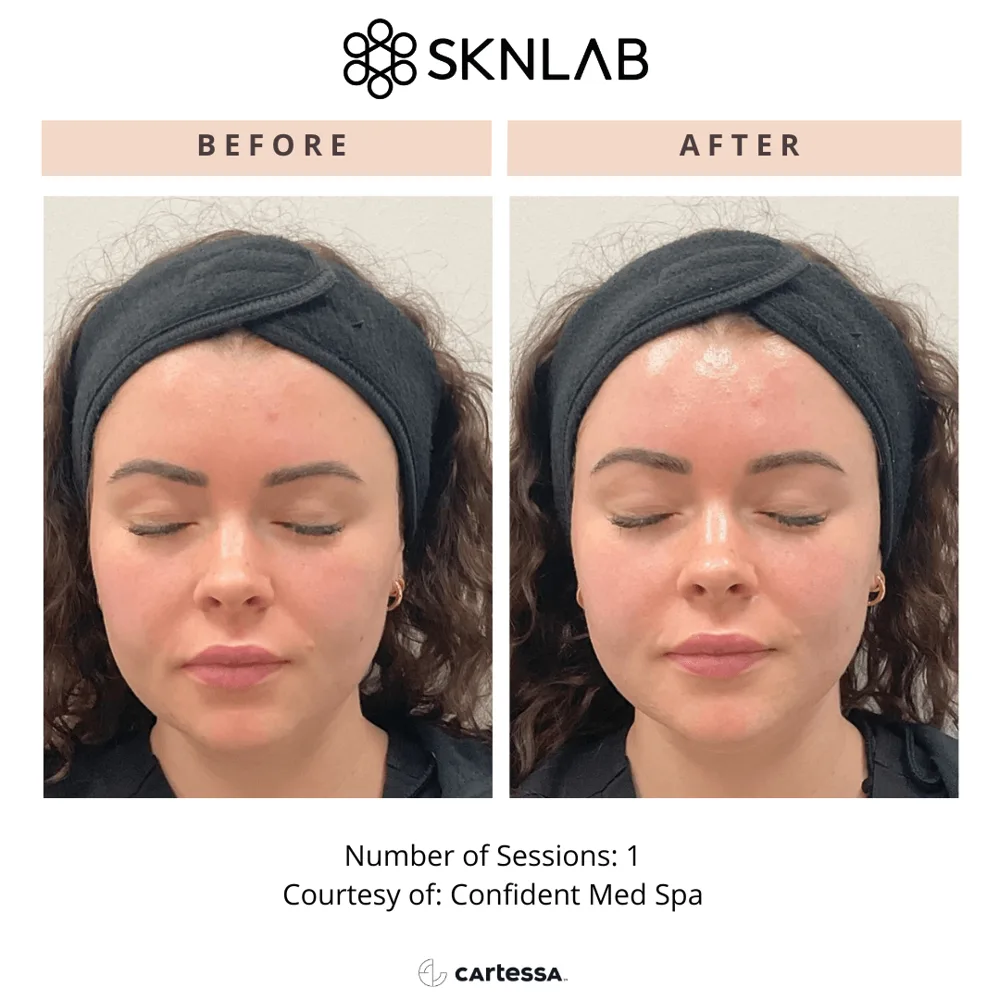 SKNLAB before and after: congested, blemish-prone skin after 1 session