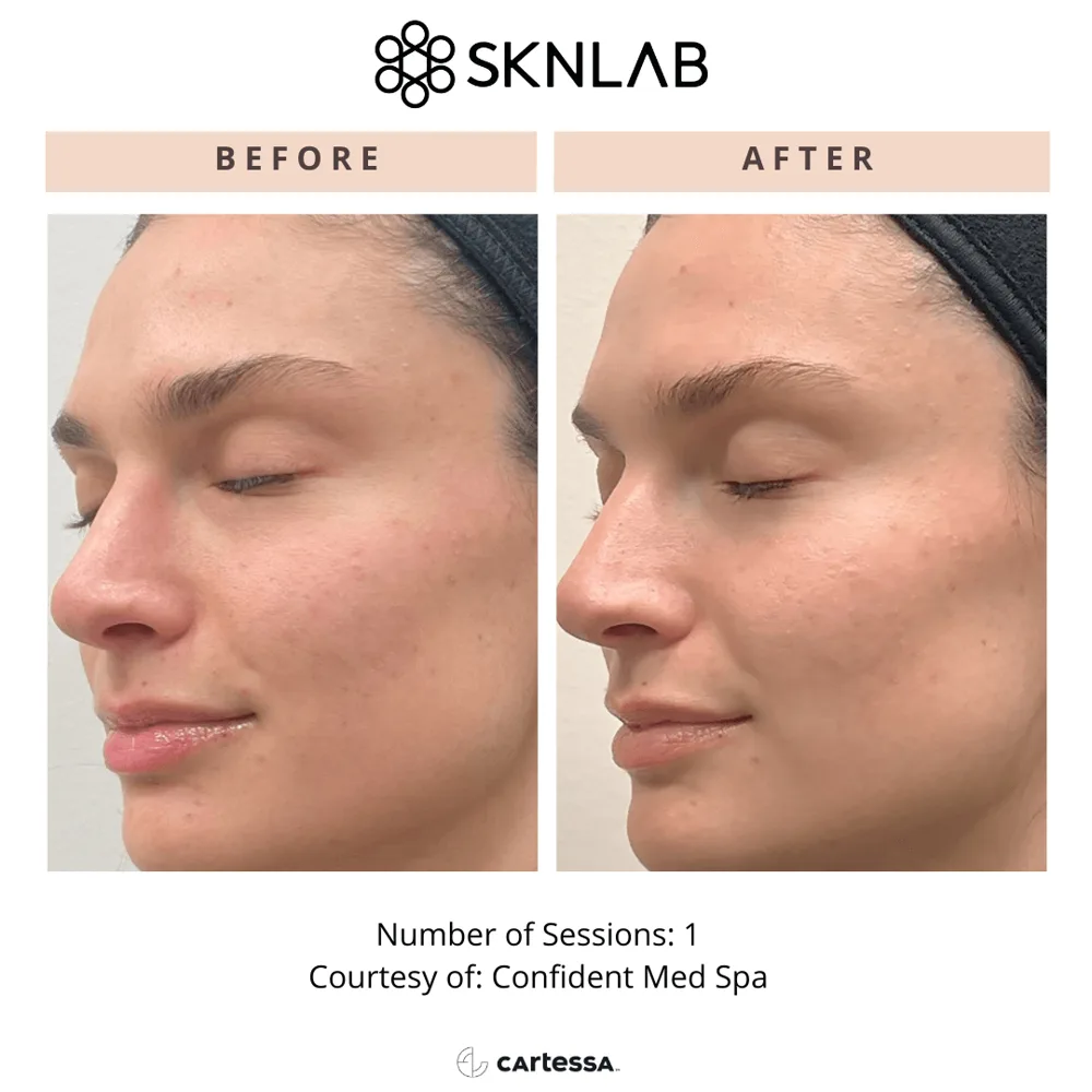SKNLAB before and after: dull, uneven skin tone after 1 session