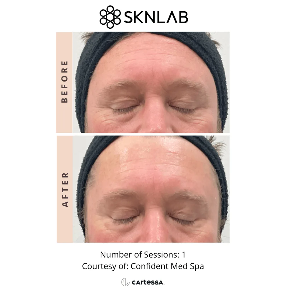 SKNLAB before and after: forehead texture and pores after 1 session