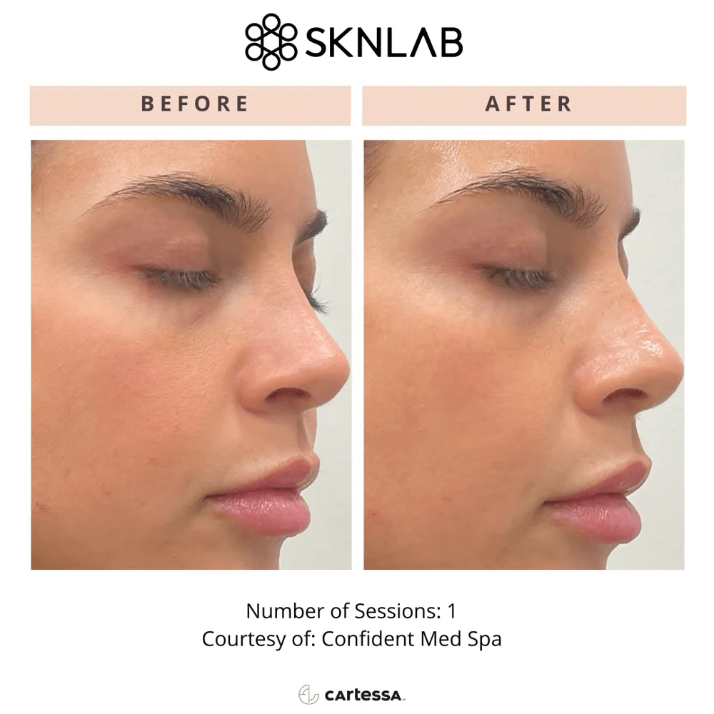 SKNLAB before and after: cheek redness and texture after 1 session