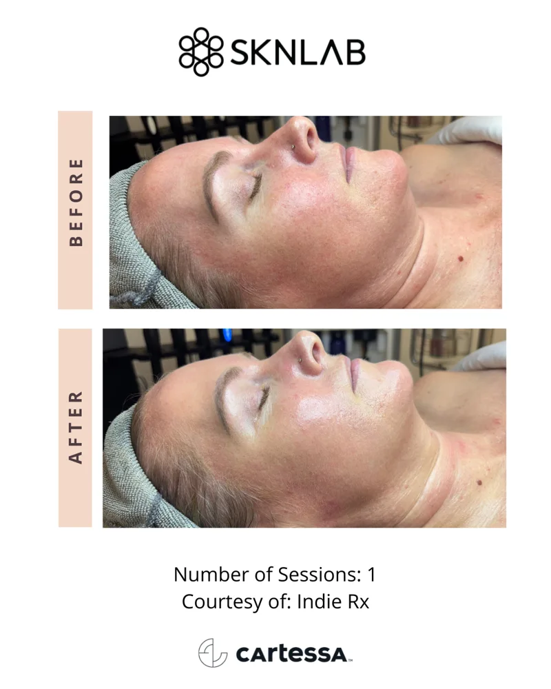 SKNLAB before and after: hydration and glow after 1 session