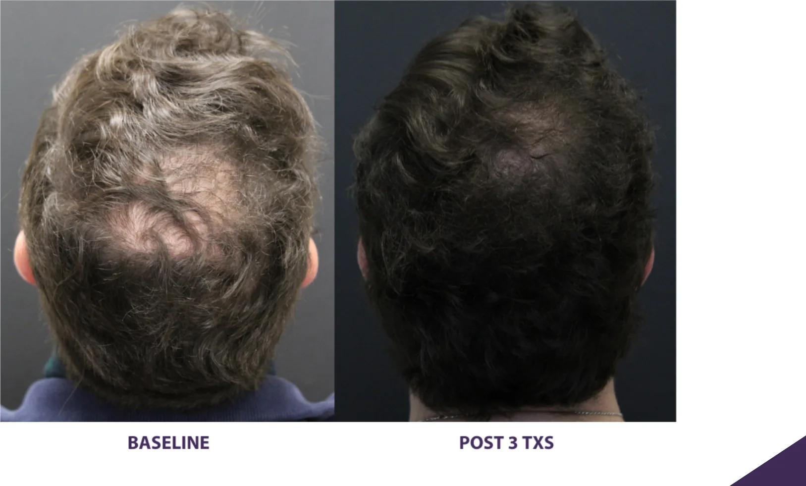 Alma TED hair restoration before and after: man's crown, after 3 treatments